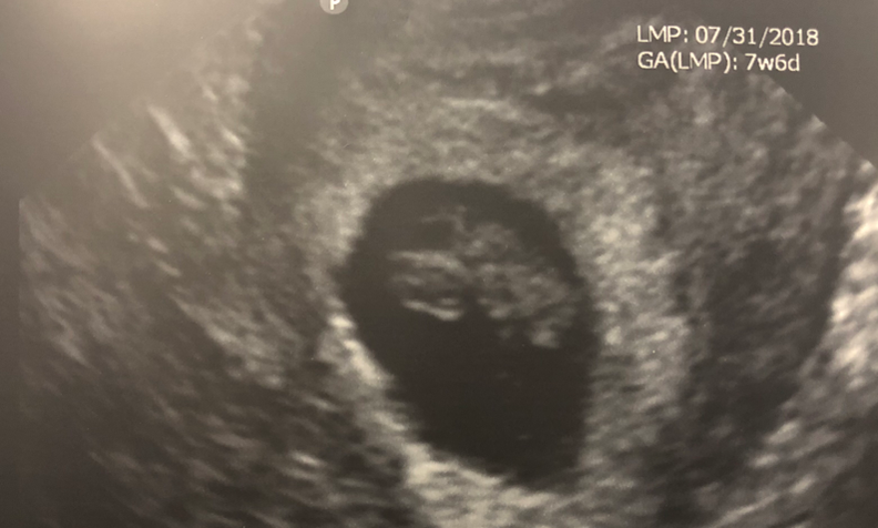 Eight Week Ultrasound